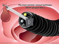 What happens during and after a colonoscopy?