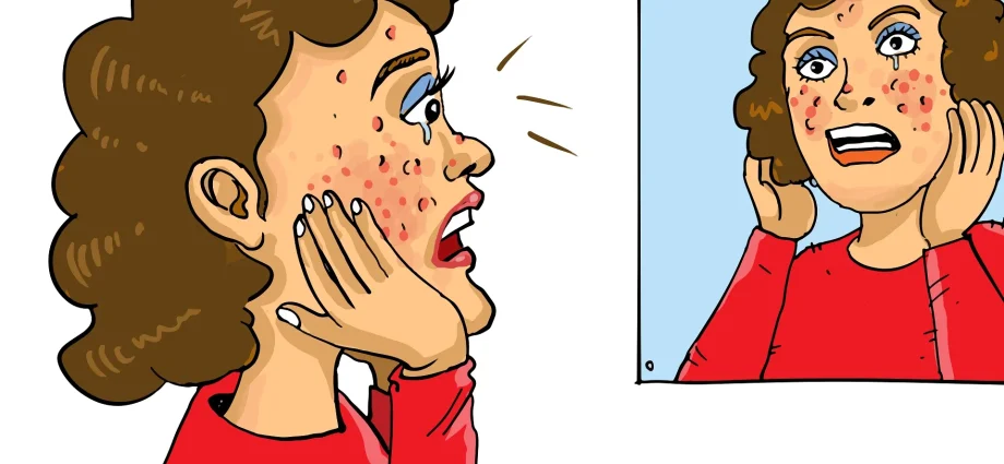 acne-zit-pimple-3-png