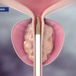 Mayo Clinic Minute: Steam treatment for enlarged prostate