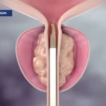 Mayo Clinic Minute: Steam treatment for enlarged prostate