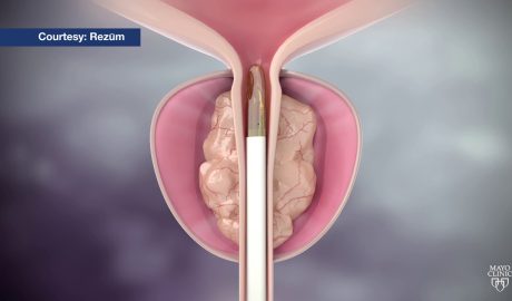 Mayo Clinic Minute: Steam treatment for enlarged prostate