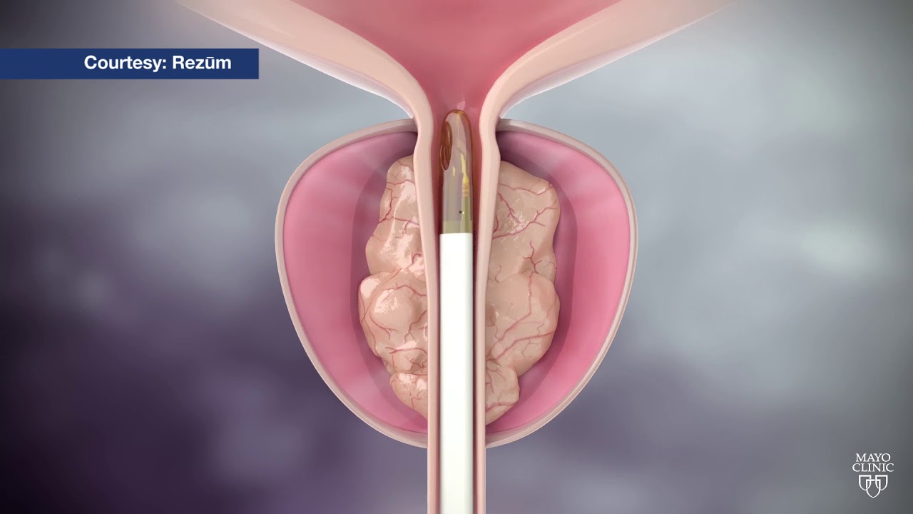Mayo Clinic Minute: Steam treatment for enlarged prostate