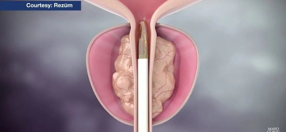 Mayo Clinic Minute: Steam treatment for enlarged prostate